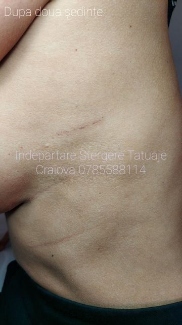 imagine galerie Îndepărtare Ștergere Tatuaje Craiova by Mădălin Șerban 4