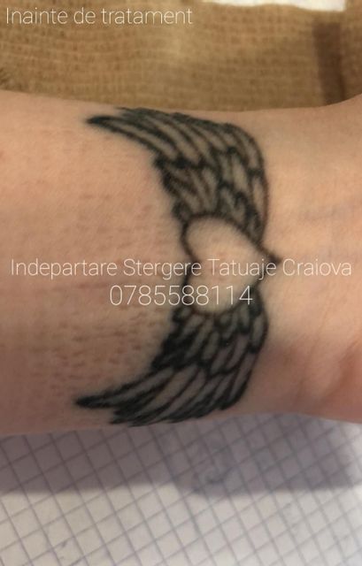 imagine galerie Îndepărtare Ștergere Tatuaje Craiova by Mădălin Șerban 3