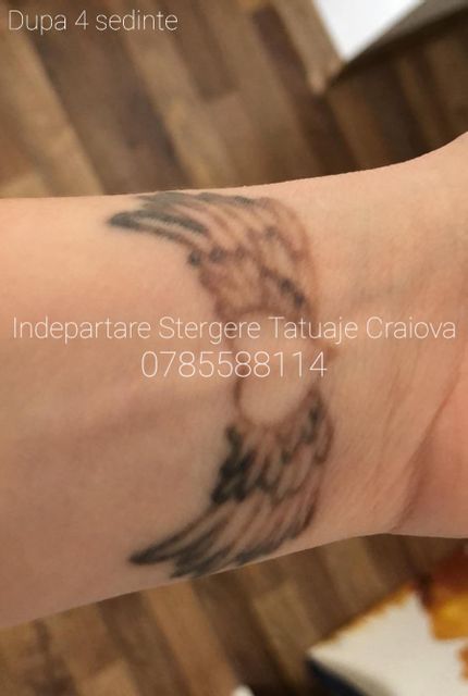imagine galerie Îndepărtare Ștergere Tatuaje Craiova by Mădălin Șerban 4