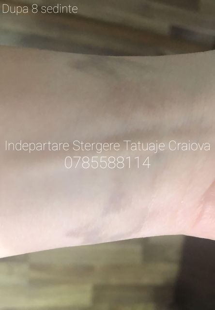 imagine galerie Îndepărtare Ștergere Tatuaje Craiova by Mădălin Șerban 5