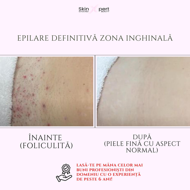 imagine galerie Epilare definitivă SkinXpert 0