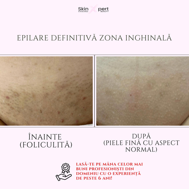 imagine galerie Epilare definitivă SkinXpert 1