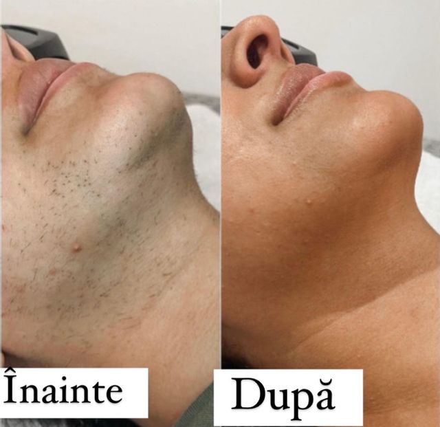 imagine galerie Epilare definitivă SkinXpert 2