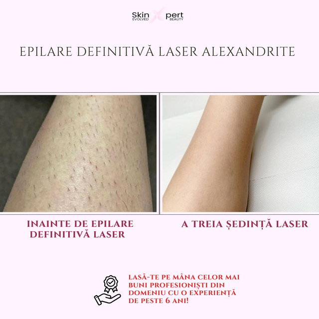 imagine galerie Epilare definitivă SkinXpert 4