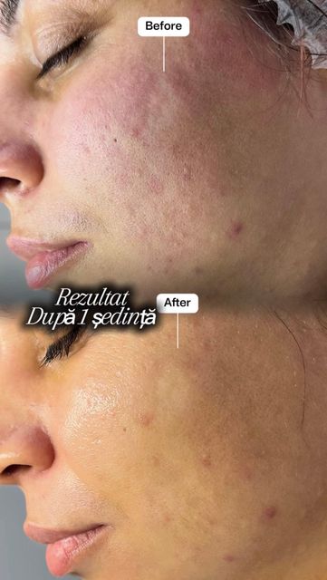imagine galerie     Dermiq | Tratamente Faciale Avansate 6